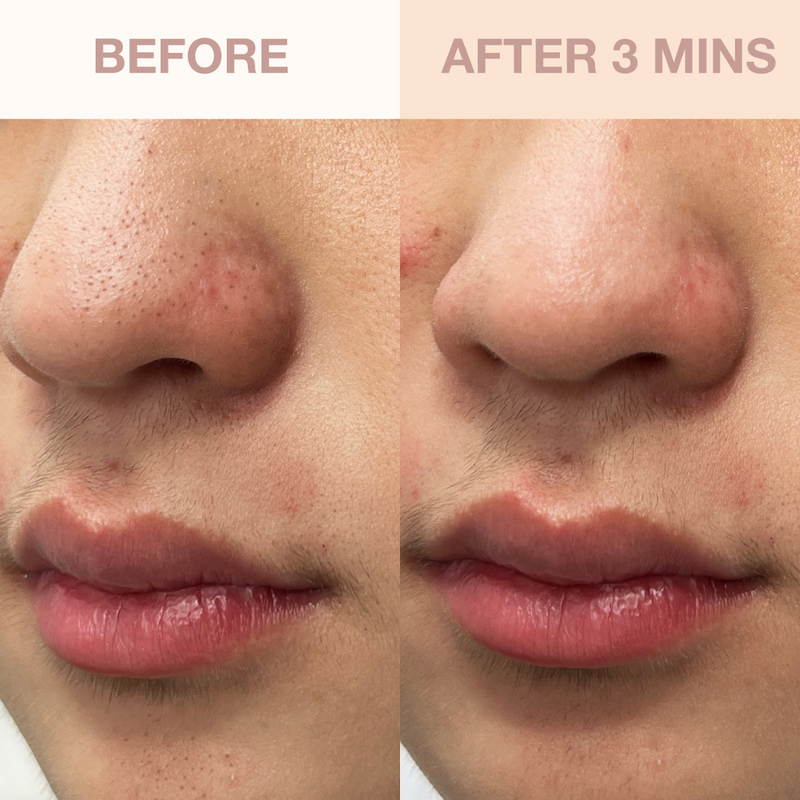 Berry Clear Skin Set | with Deepcare O2 Hydro-Facial Pore Refiner Device & ABC Serum